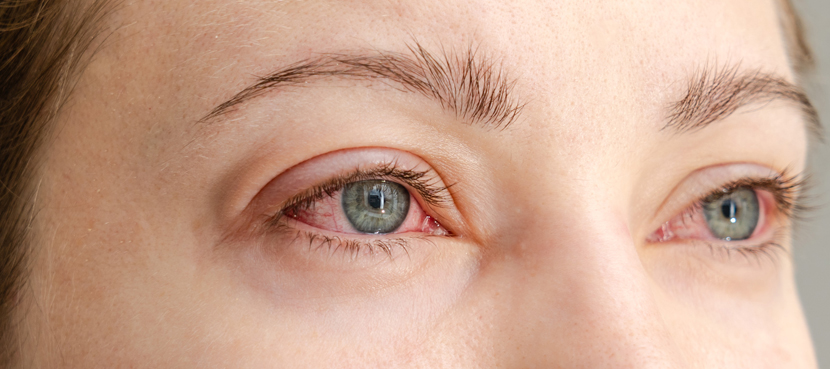 Minor Eye Conditions Service (MECS)