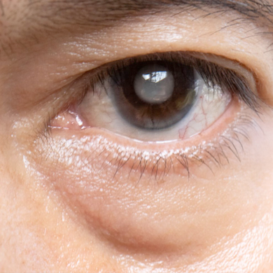 Glaucoma Monitoring Services