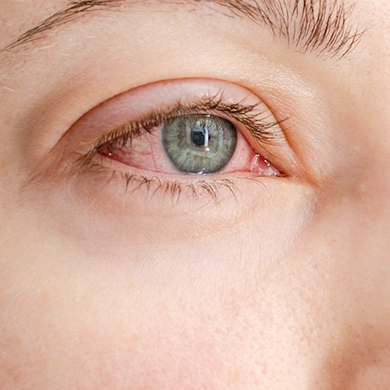 Minor Eye Conditions Service (MECS)